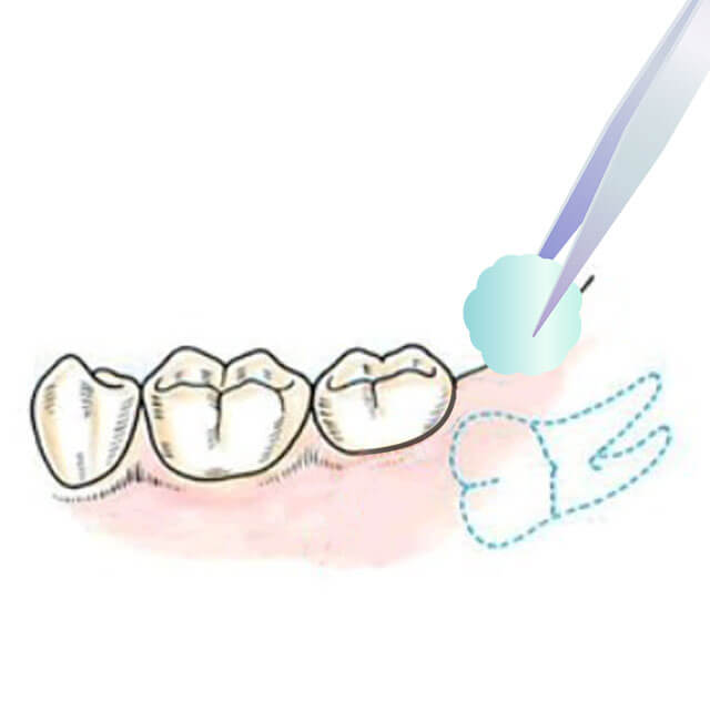 抜歯部位及びその周囲の消毒をします
