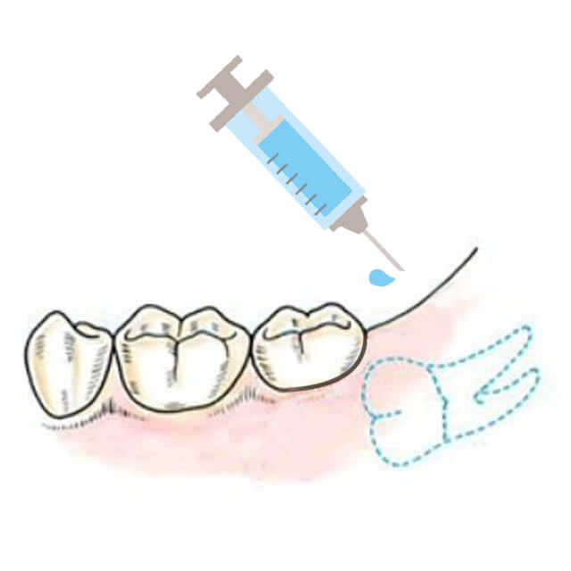 抜歯部位周囲に麻酔