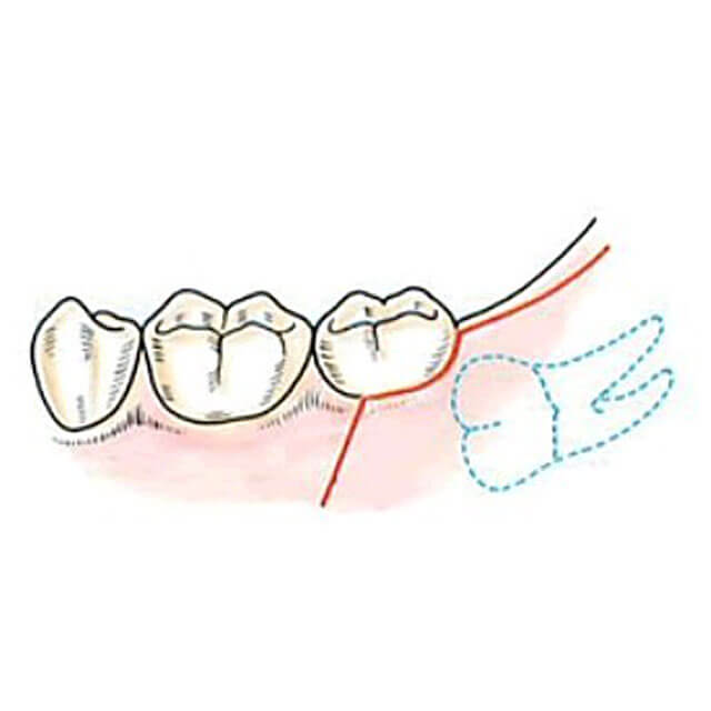 親知らずの周りの歯ぐきに切開を行います