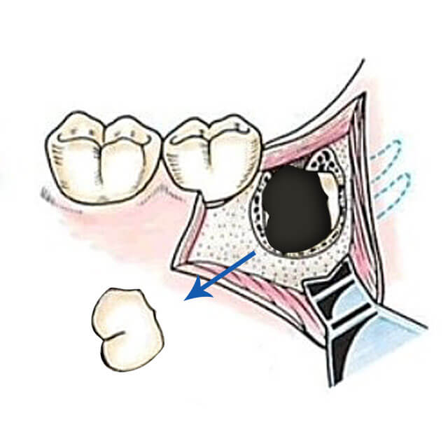 残った歯根部分を抜歯します