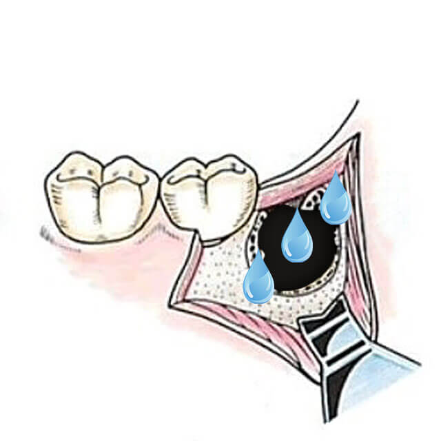 抜歯部を生理食塩水にて入念に洗浄します