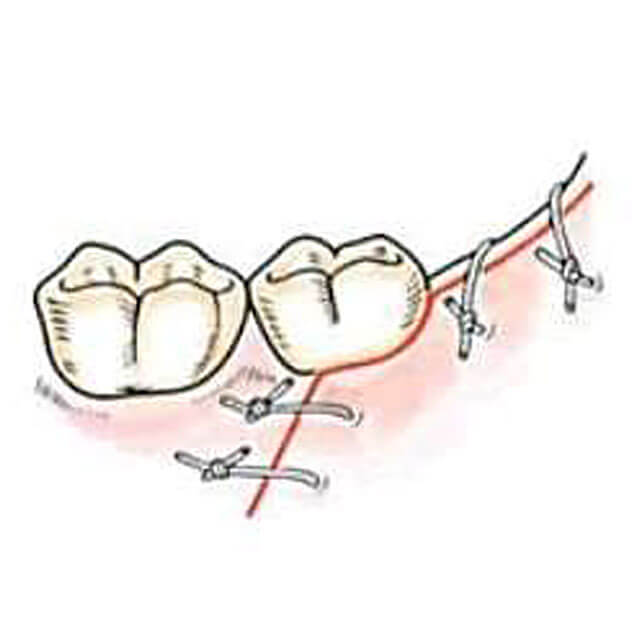 切開した粘膜を縫い合わせます