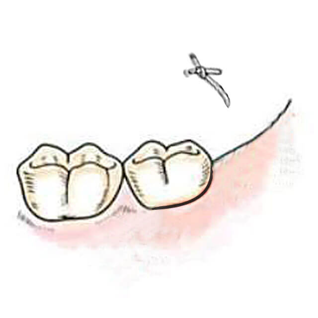 縫合した場合は抜歯後約１週間で抜糸します