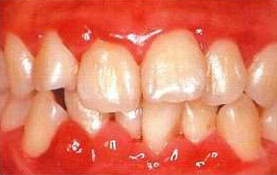 妊娠中になりやすいお口のトラブル