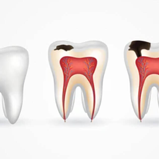 虫歯になりやすい