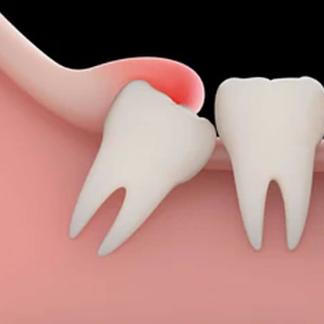 親知らずが炎症を起こしやすくなる
