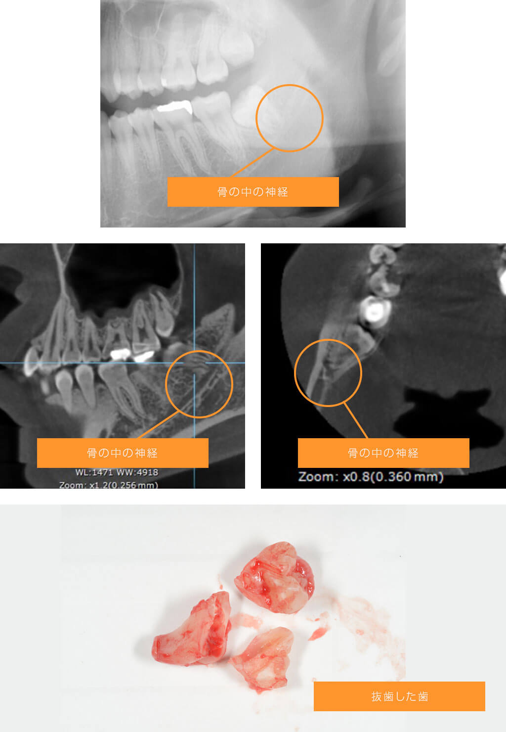 症例１　下顎の神経と左下の親知らずが近接している場合