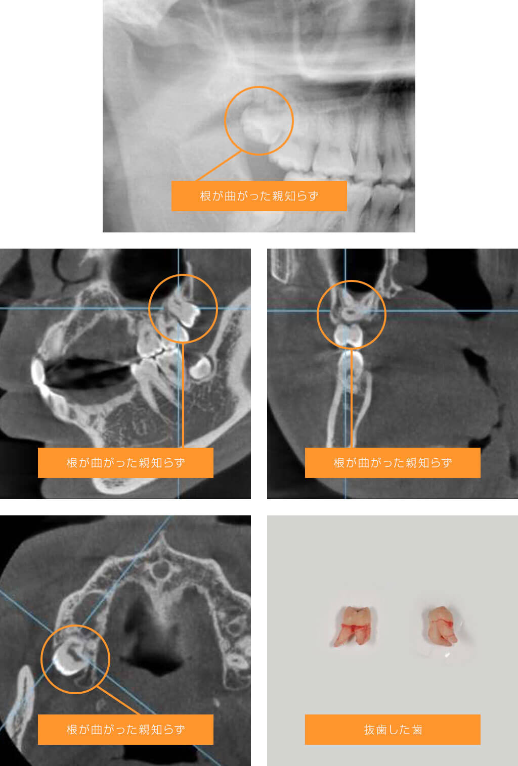 症例２　極端に根が曲がっている左上の親知らずの場合