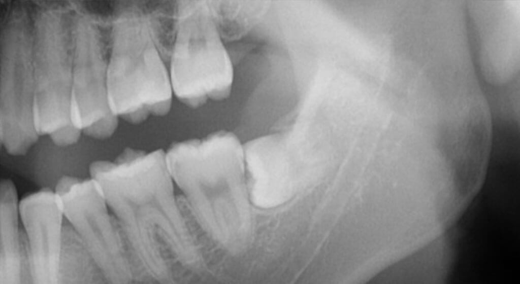 親知らずの画像