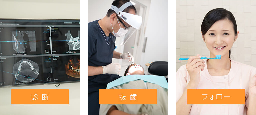 当院での親知らずの抜歯について